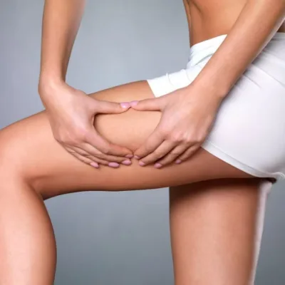 Cellulite, Affrontala con una Routine Sana: Cibi da Evitare, Cibi da Preferire, Attività Fisica e Drenaggio dei Liquidi