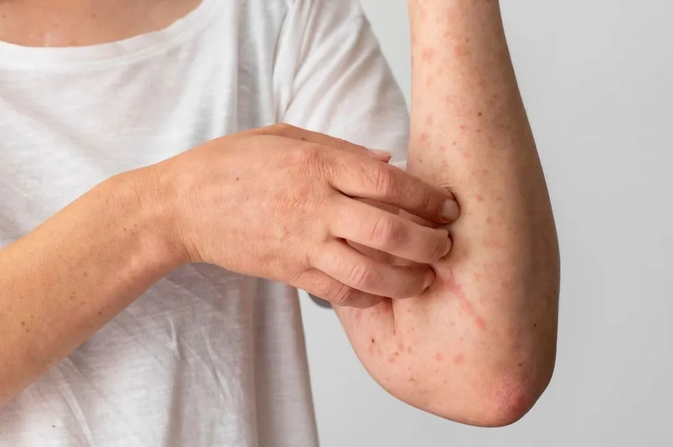 Dermatite Atopica